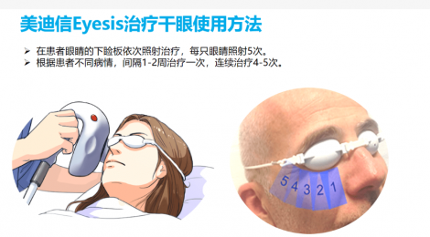 舒緩眼部不適， 干眼理療儀成為您的良好選擇