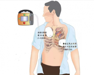 心電圖機(jī)的正確使用步驟是什么？朗逸器械百科