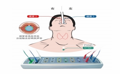 20250331_喉返神經(jīng)監(jiān)測儀_20250331_130356_6259 03-31-2025
